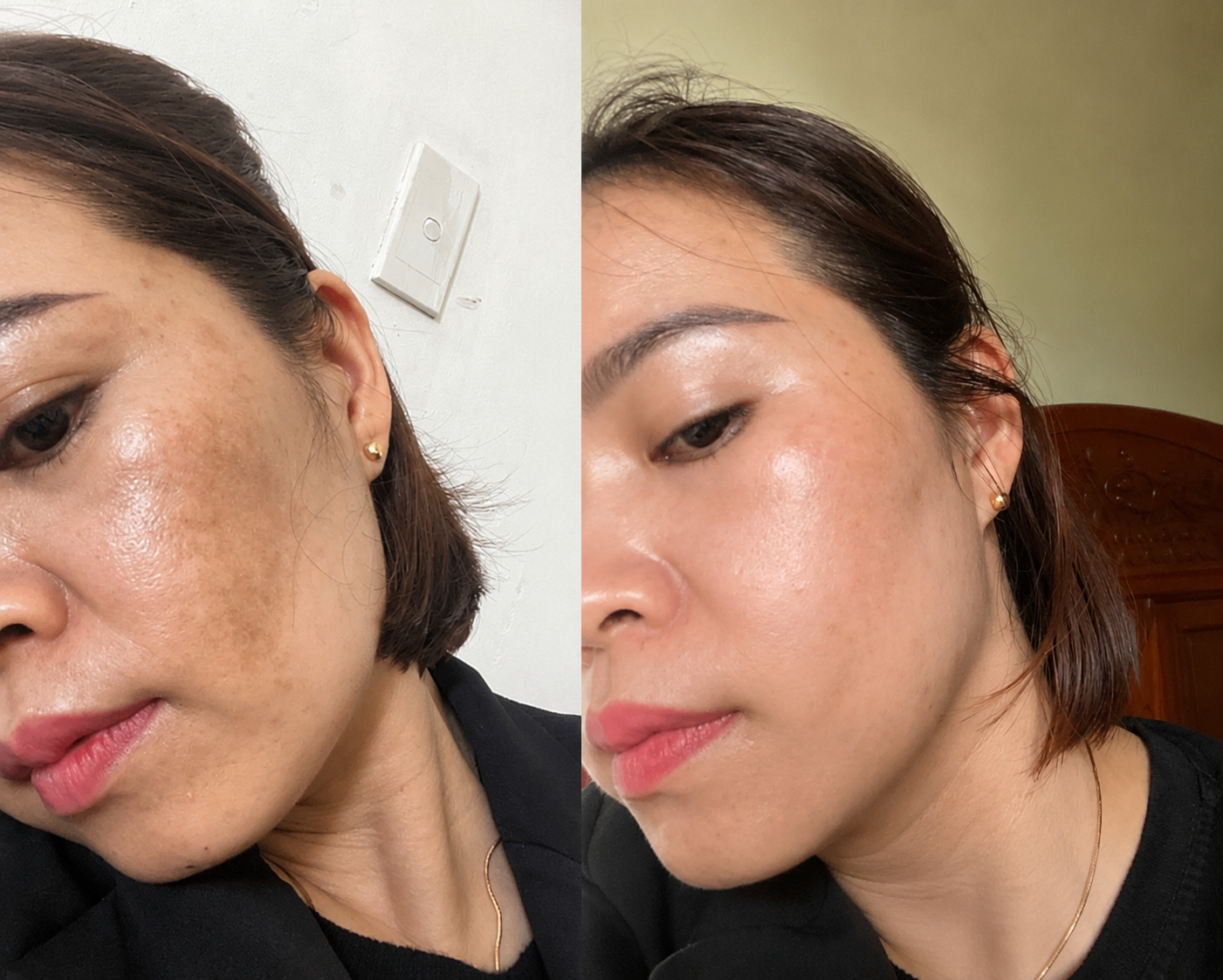 Kết quả da sau peel - Chị Minh Anh