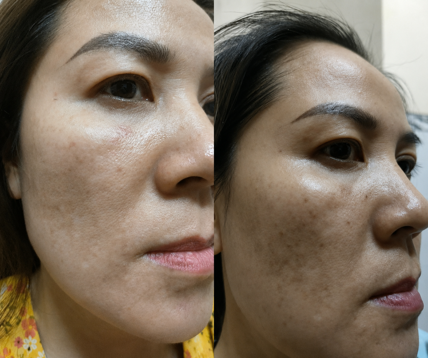 Kết quả da mỏng yếu - Chị Thu Hà