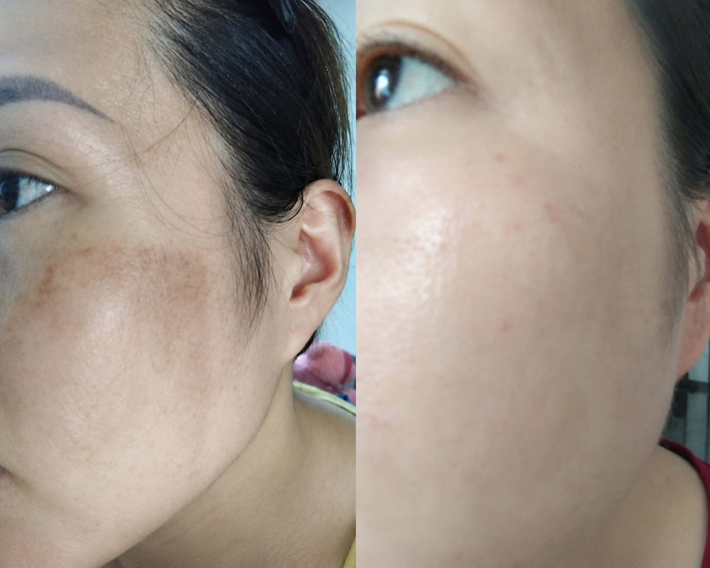 Kết quả da sạm không đều màu - Chị Lan Phương